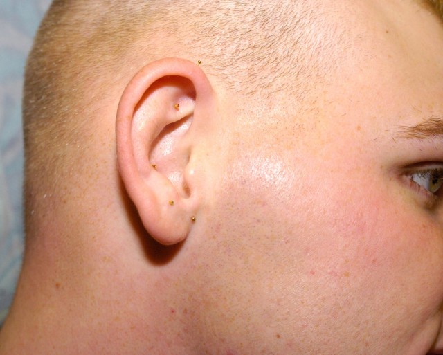 Easing pain with acupuncture