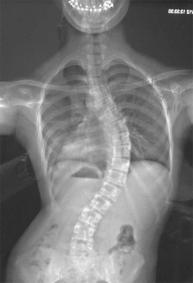 Scoliosis