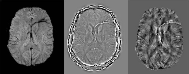 New imaging technique detects changes in veins that may better illuminate brain injury