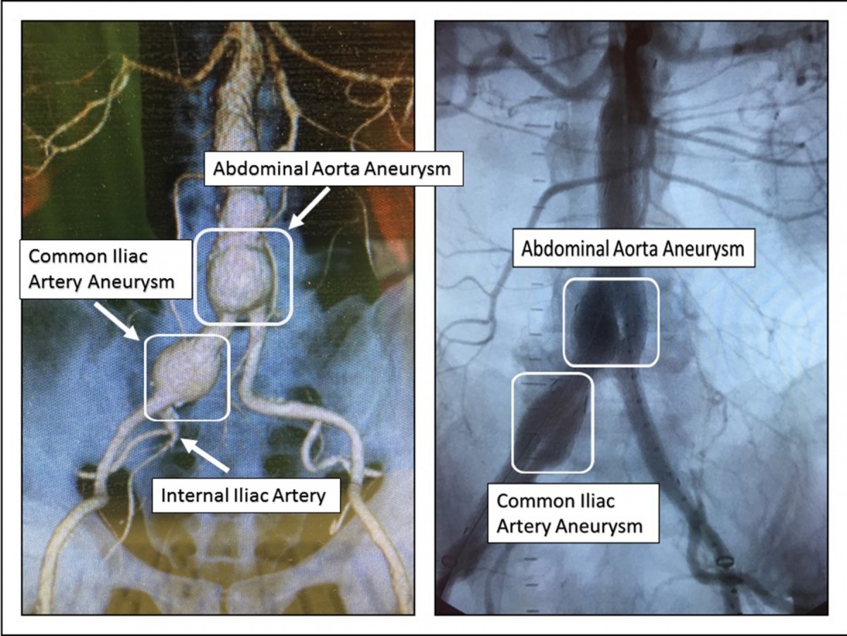 common iliac artery ectasia