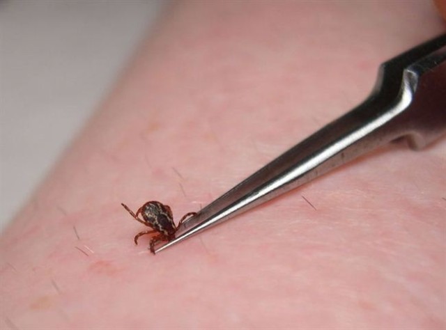 Tick Removal