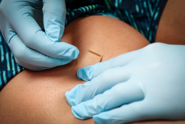 BACH Physical Therapy hosts course in dry needling