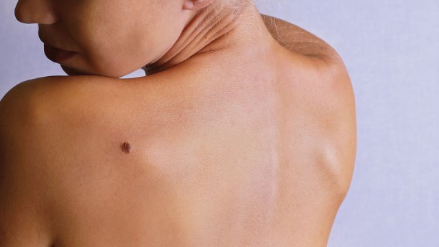 Too much sun poses health risk