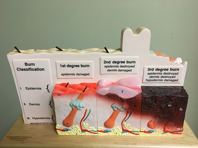 Comparison of burn-degree levels