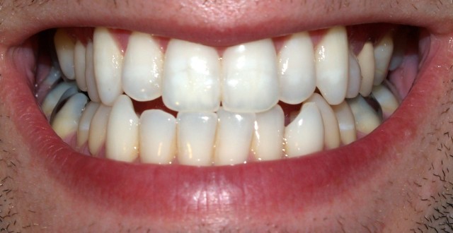 Changes coming to the TRICARE Retiree Dental Program