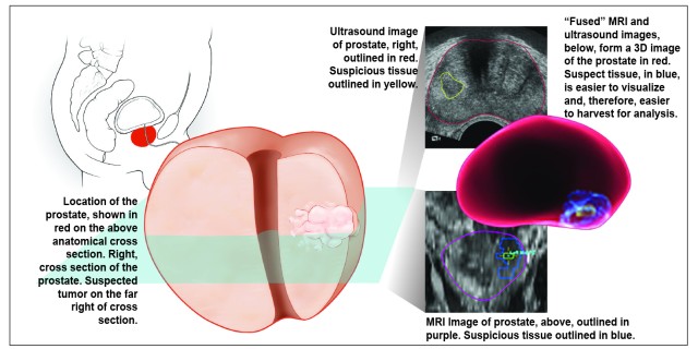 'Fused' technologies give 3D view of prostate during biopsy