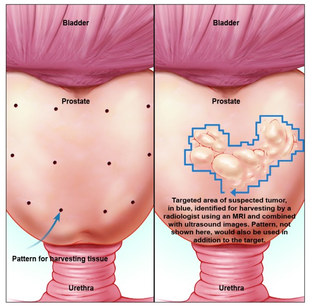 'Fused' technologies give 3D view of prostate during biopsy