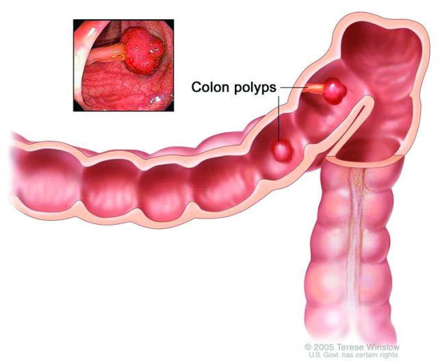 Caring about your colon