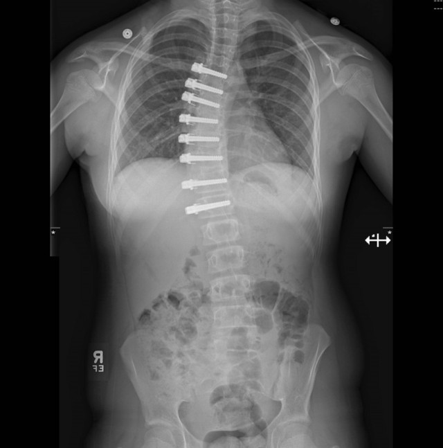 Post-operative X-ray with VBT in Patient Boyll