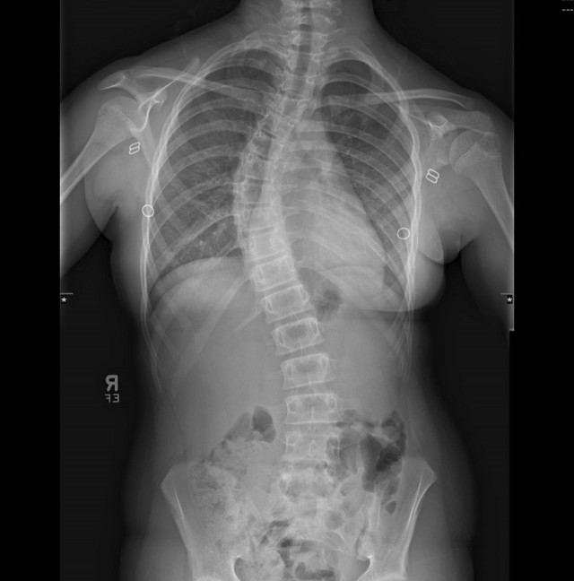 Pre-operative X-ray of spinal curvature in Patient Boyll