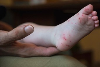 Hand, foot and mouth disease: What parents need to know
